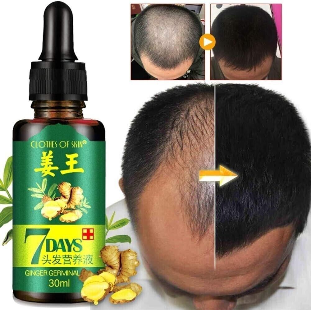 7 Days Hair Growth Serum Oil | Ginger Germinal Hair Regrowth Essence (3 x 30ml Bottles)
